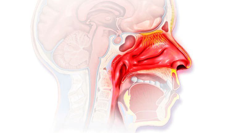 Xịt và rửa mũi đúng cách giúp làm sạch khoang mũi mà không gây tổn thương niêm mạc