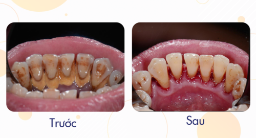 Cao răng bám cứng ở chân răng gây tụt nướu và hôi miệng