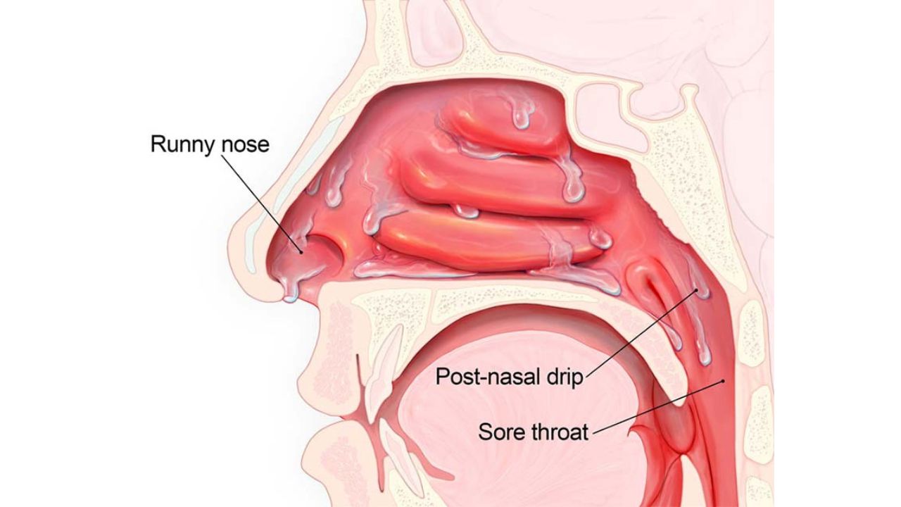 Chảy dịch mũi sau là nguyên nhân phổ biến khiến họng bị vướng và cơn ho kéo dài hơn