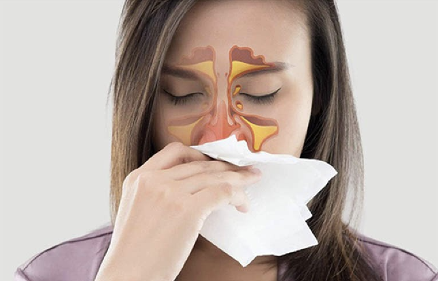 Cơ chế viêm mũi dị ứng liên quan đến histamine gây nghẹt mũi và ngứa mũi
