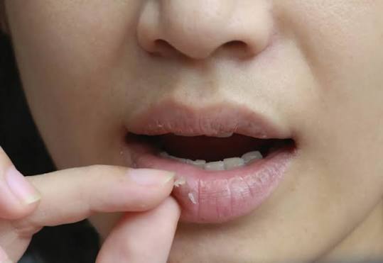 Miệng khô, tiểu ít và chóng mặt là những dấu hiệu cảnh báo mất nước khi sốt