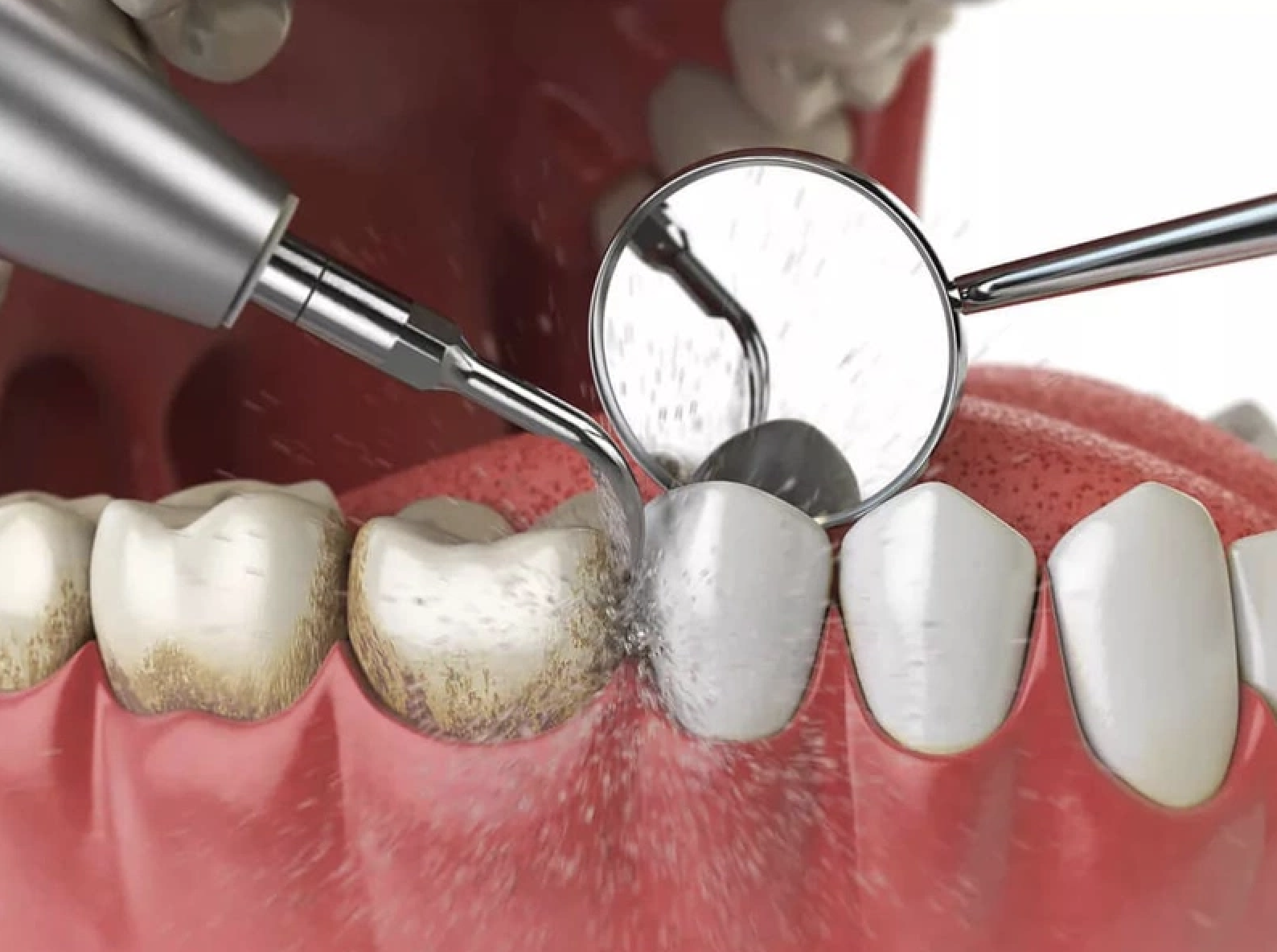 Lấy cao răng định kỳ giúp ngăn ngừa viêm nướu và sâu răng