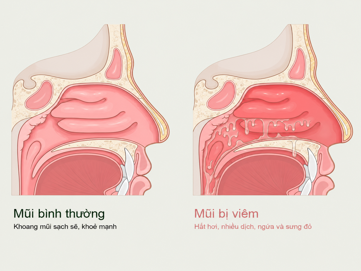 Vận động phù hợp giúp người viêm mũi dị ứng giảm cảm giác tắc nghẽn trong thời gian ngắn