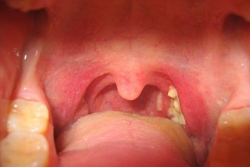 Xác định đúng nguyên nhân giúp tránh dùng kháng sinh không cần thiết khi bị viêm họng